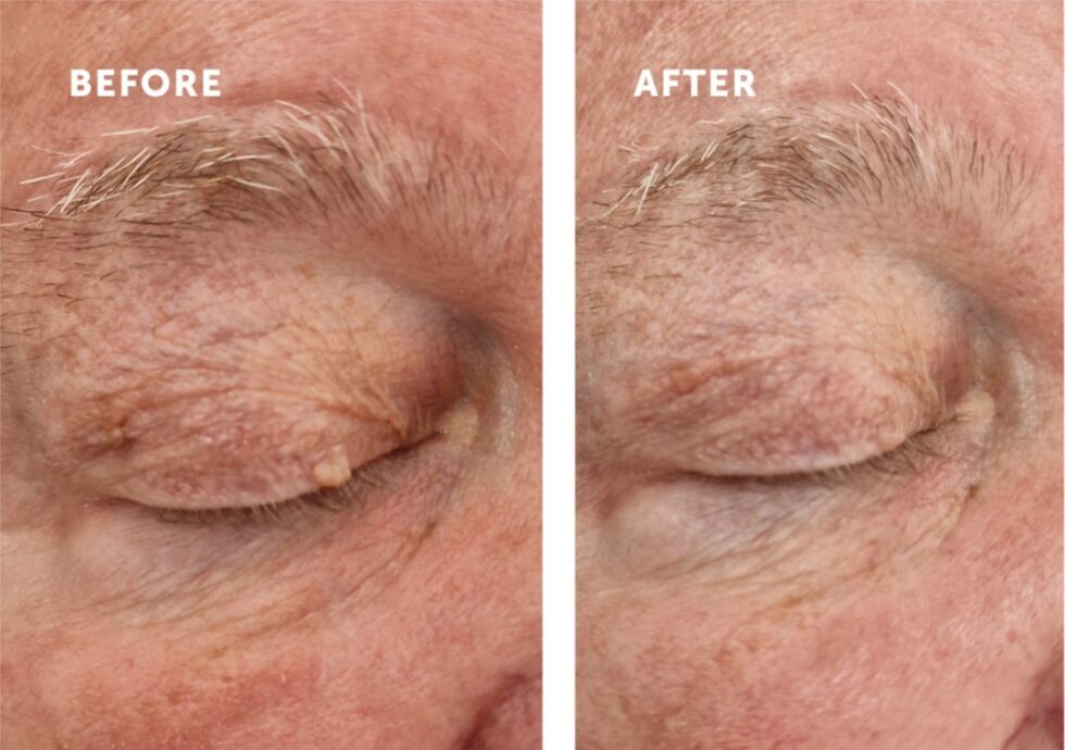 Mayfair clinic offers same-day removal of skin tags and age spots with CryoPen