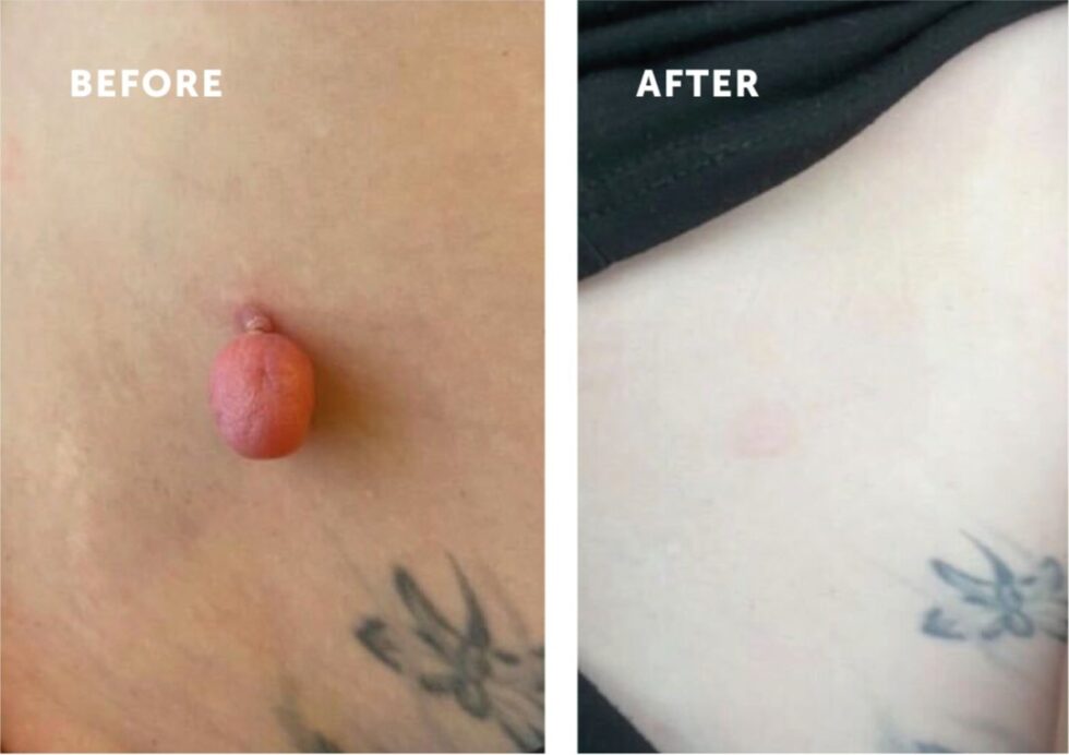 Mayfair clinic offers same-day removal of skin tags and age spots with CryoPen